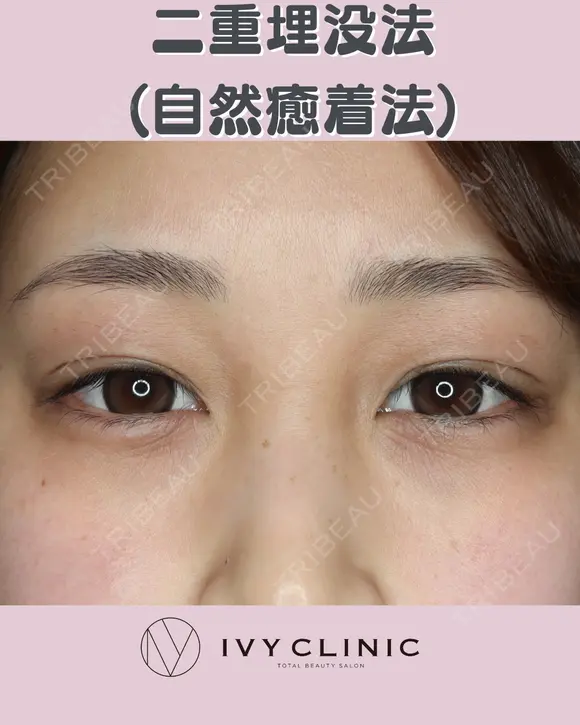 二重埋没(自然癒着) before画像 メイン用