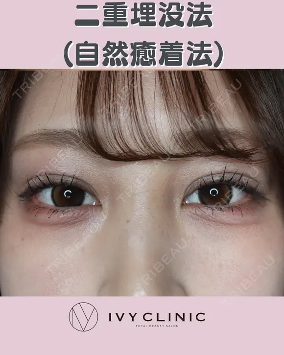 二重埋没(自然癒着) after画像 メイン用