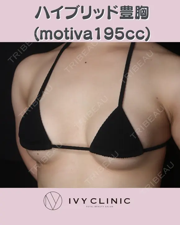 ハイブリッド豊胸(motiva195cc) after画像 メイン用