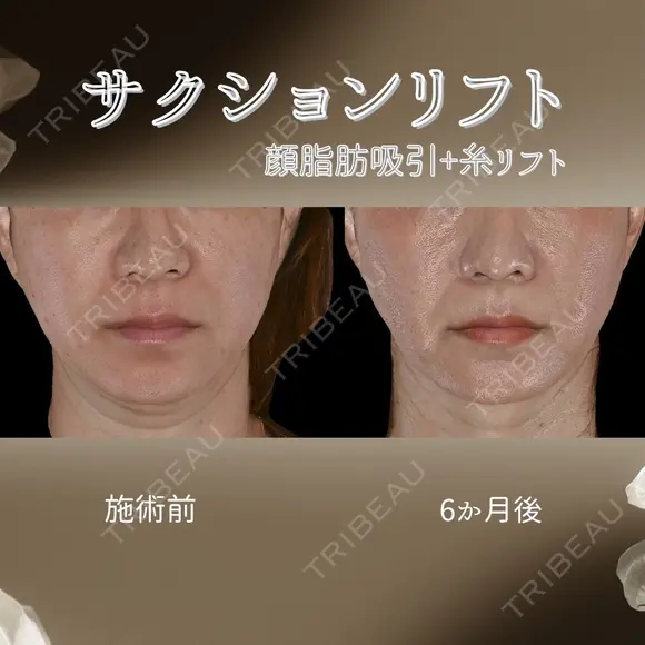 サクションリフト 180日後 メイン用