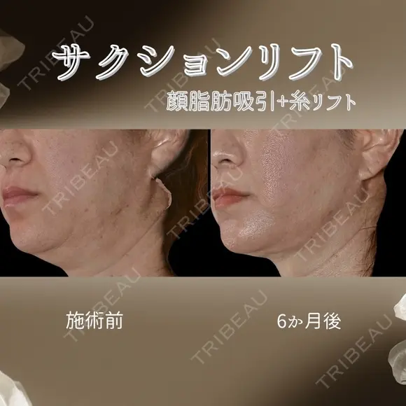 サクションリフト 180日後 メイン用