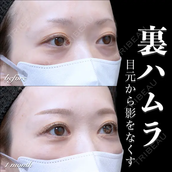 裏ハムラ 30日後 メイン用