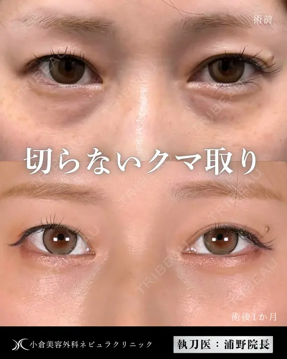 Dr浦野執刀🌿切らない目の下のクマ取り before画像 メイン用