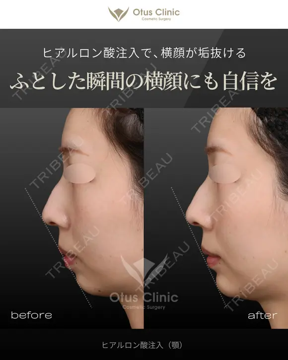 ヒアルロン酸注入（顎） before画像 メイン用