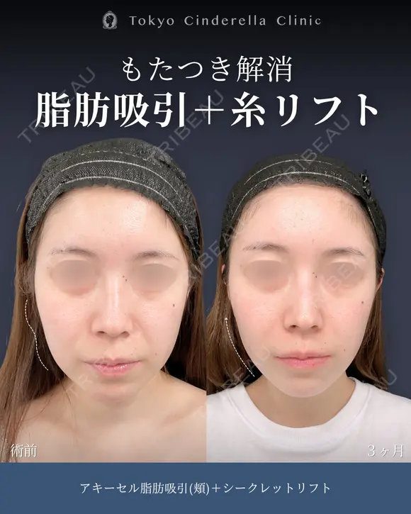 アキーセル脂肪吸引(頬)/シークレットリフト8本 90日後 メイン用
