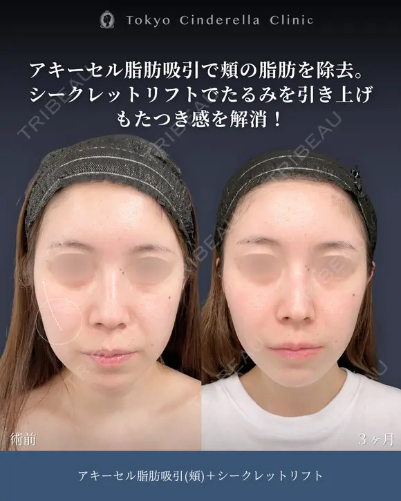 アキーセル脂肪吸引(頬)/シークレットリフト8本 before画像 メイン用