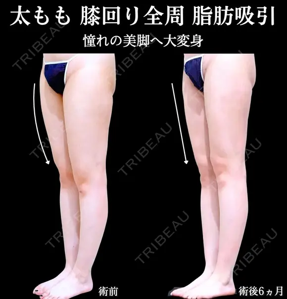 太もも全面　膝全周　脂肪吸引 180日後 メイン用