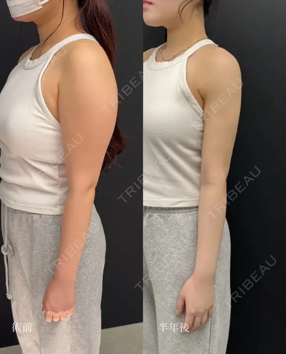 シークレット脂肪吸引 before画像 メイン用
