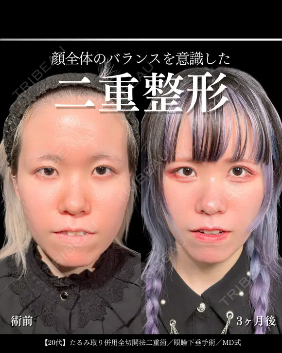 たるみ取り併用全切開二重術/眼瞼下垂手術/MD式 90日後 メイン用