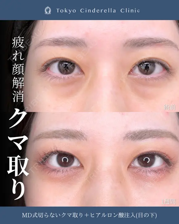切らないクマ取り/ヒアルロン酸注入(目の下)/MD式 7日後 メイン用