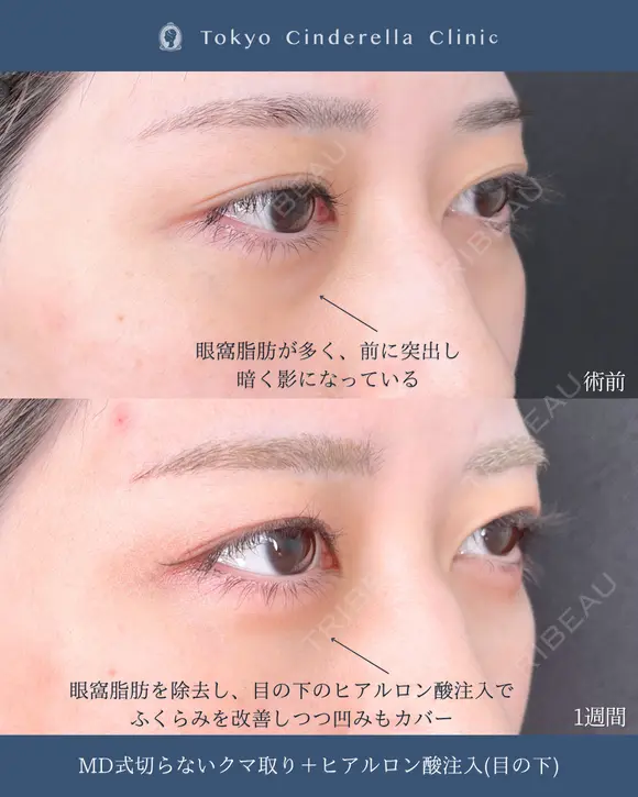切らないクマ取り/ヒアルロン酸注入(目の下)/MD式 before画像 メイン用