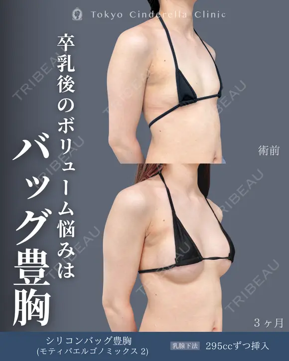 シリコンバッグ豊胸(モティバエルゴノミックス2) before画像 メイン用