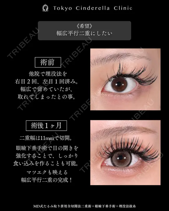 たるみ取り併用全切開法二重術/眼瞼下垂手術/埋没法抜糸/MD式 before画像 メイン用