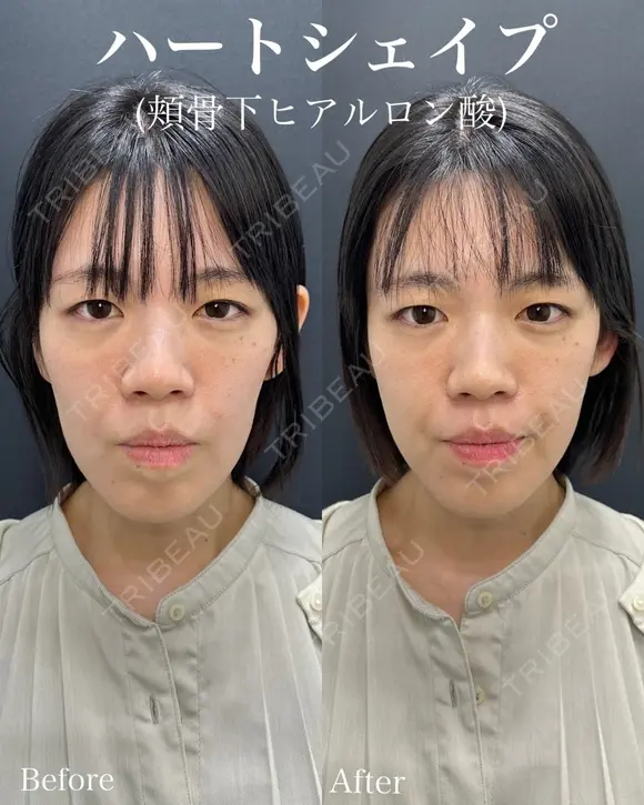 ハートシェイプほほ骨下ヒアルロン酸（ボリューマ）2cc before画像 メイン用