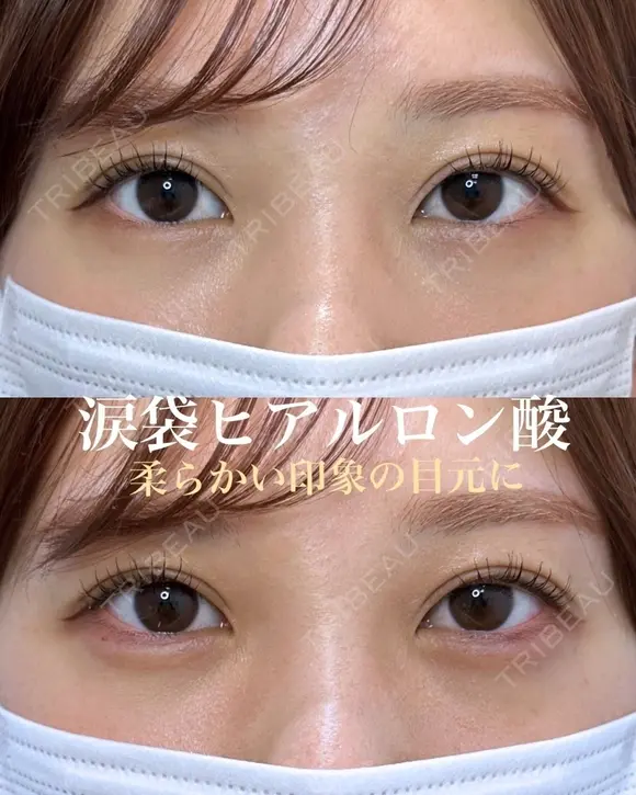 涙袋ヒアルロン酸（ボルベラ） after画像 メイン用