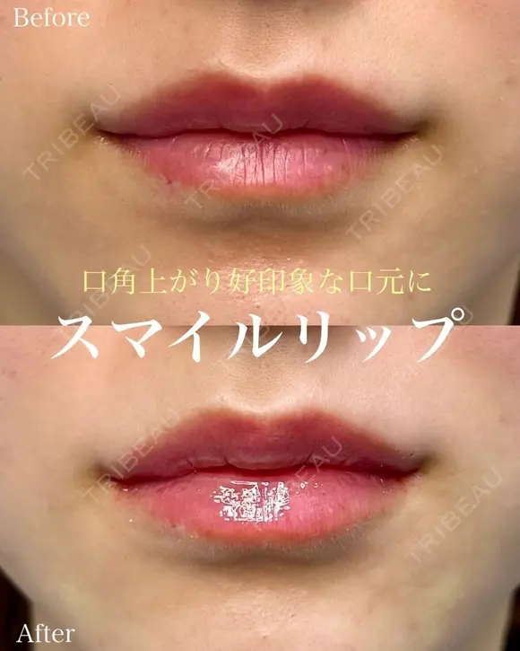 スマイルリップ（ボルベラ） before画像 メイン用