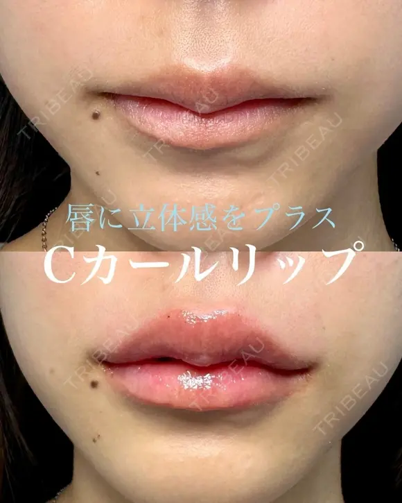 Cカールリップ（ボルベラ） before画像 メイン用