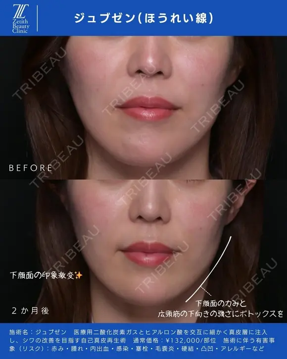 ジュブゼン（ほうれい線） before画像 メイン用