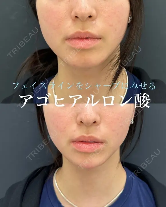 アゴヒアルロン酸（ボラックス） after画像 メイン用