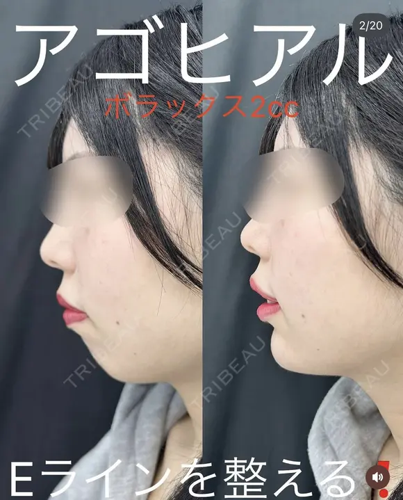 アゴ(ボラックス2㏄) after画像 メイン用