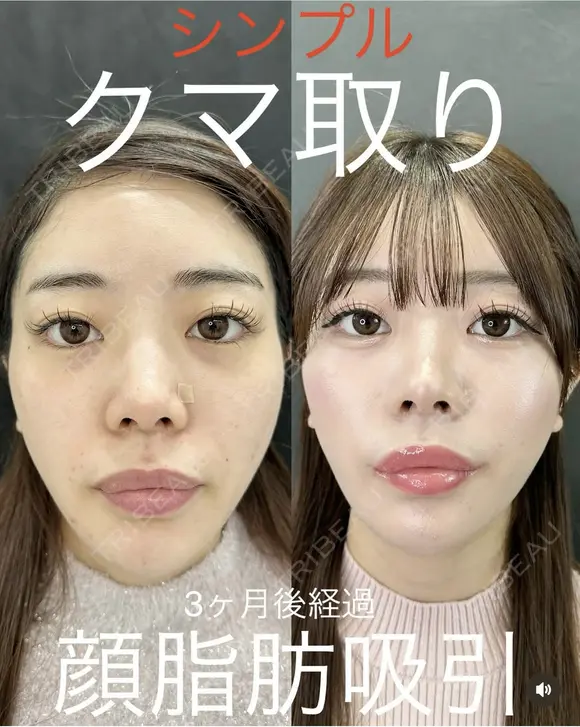 クマ取り・脂肪吸引(顔) before画像 メイン用