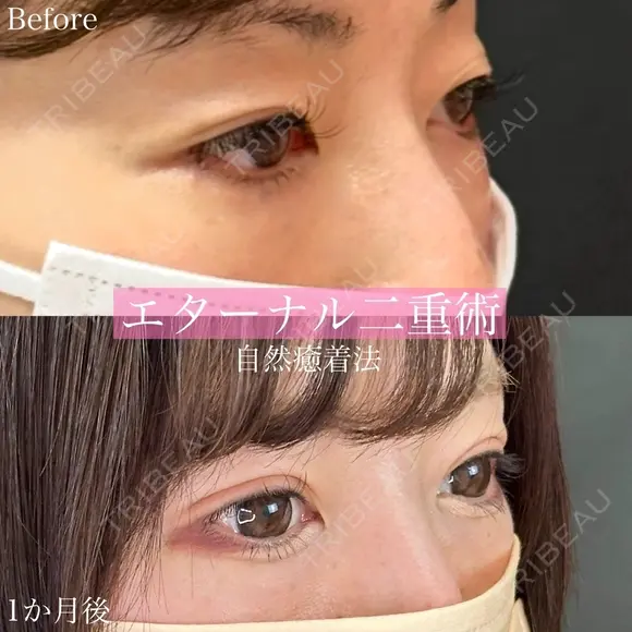エターナル二重術 before画像 メイン用