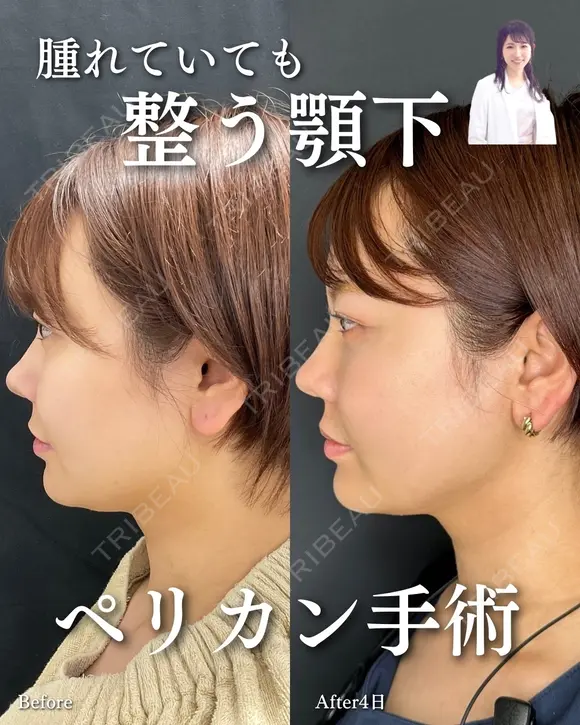 ペリカン手術 before画像 メイン用