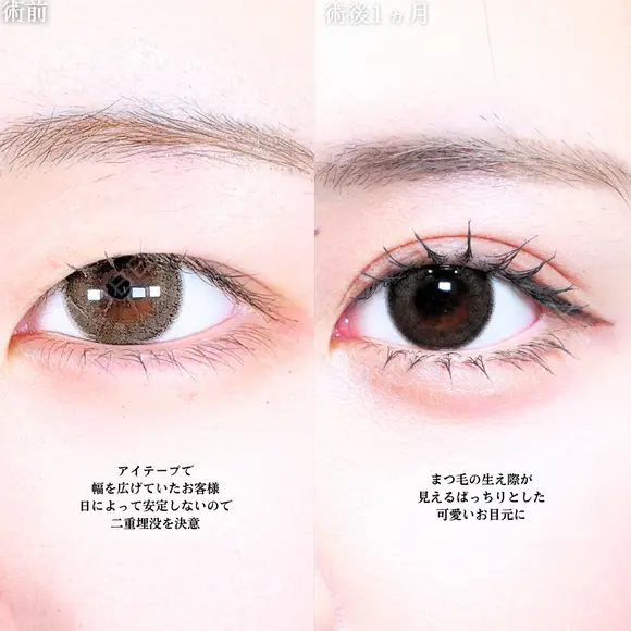 アリエルクイックループトリプル二重埋没法 before画像 メイン用