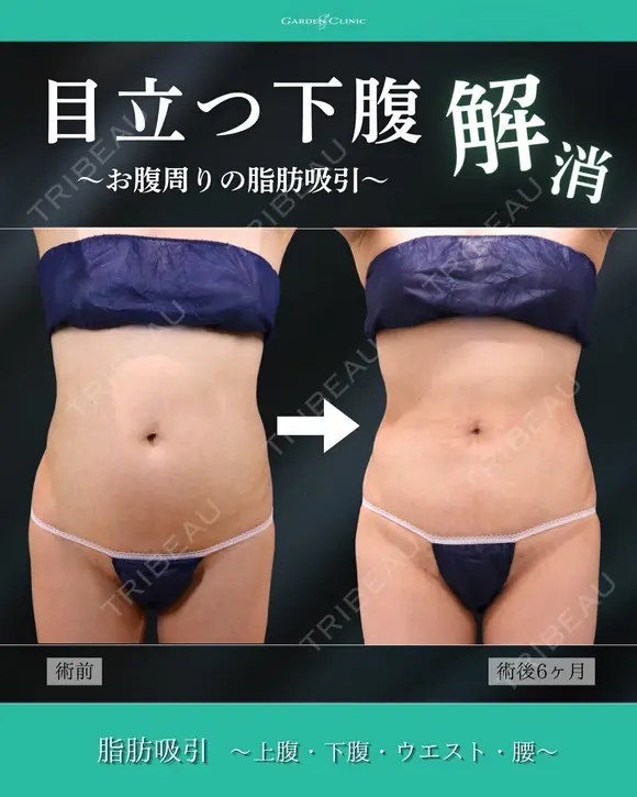 目立つ下腹解消！🌟 before画像 メイン用