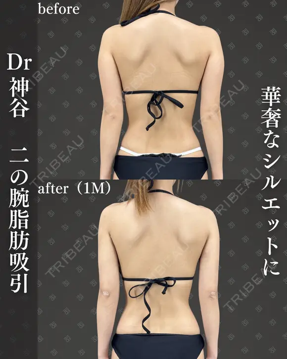 二の腕脂肪吸引（二の腕全周、肩、ブラファット） before画像 メイン用