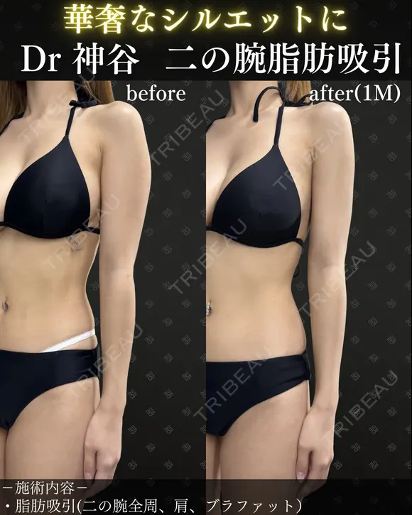 二の腕脂肪吸引（二の腕全周、肩、ブラファット） after画像 メイン用