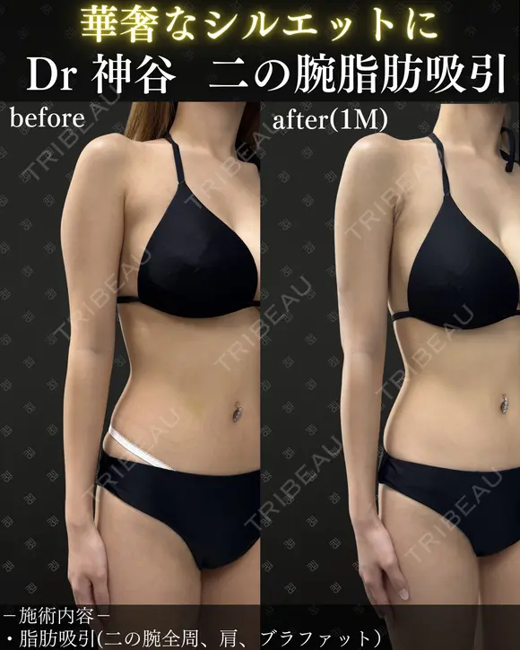 二の腕脂肪吸引（二の腕全周、肩、ブラファット） after画像 メイン用