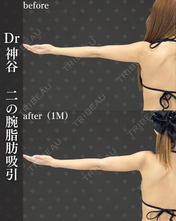 二の腕脂肪吸引（二の腕全周、肩、ブラファット） after画像 メイン用