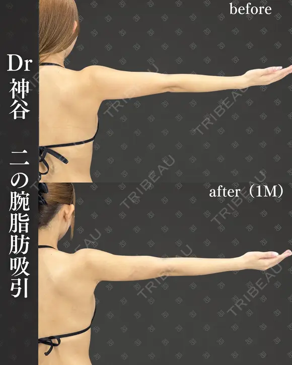 二の腕脂肪吸引（二の腕全周、肩、ブラファット） after画像 メイン用