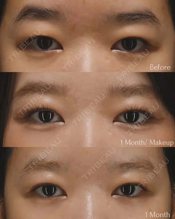二重埋没 before画像 メイン用
