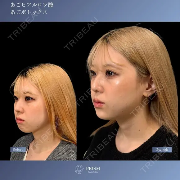 Eライン形成💖《あごヒアルロン酸×あごボトックス》 after画像 メイン用