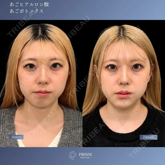 Eライン形成💖《あごヒアルロン酸×あごボトックス》 after画像 メイン用