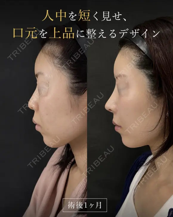鼻フルカスタム before画像 メイン用