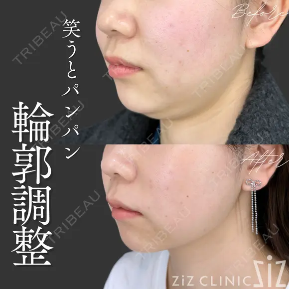 【輪郭調整】笑うとパンパン after画像 メイン用