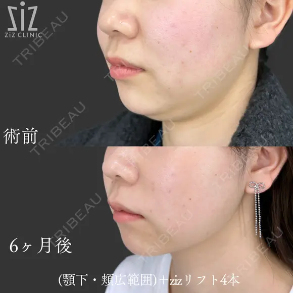 【輪郭調整】笑うとパンパン before画像 メイン用