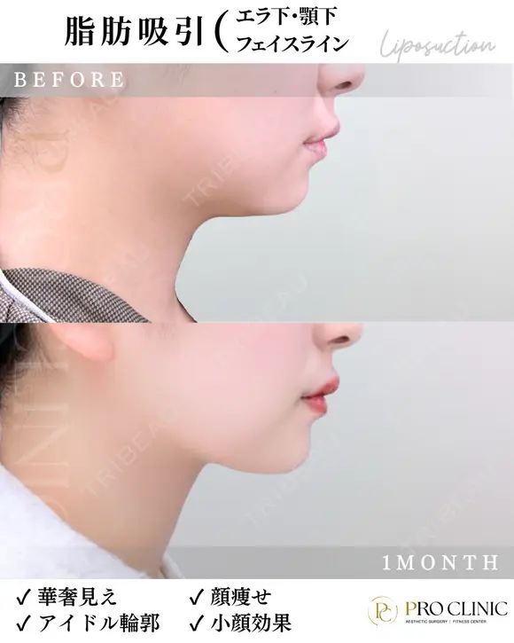 脂肪吸引（エラ下・あご下・フェイスライン） after画像 メイン用