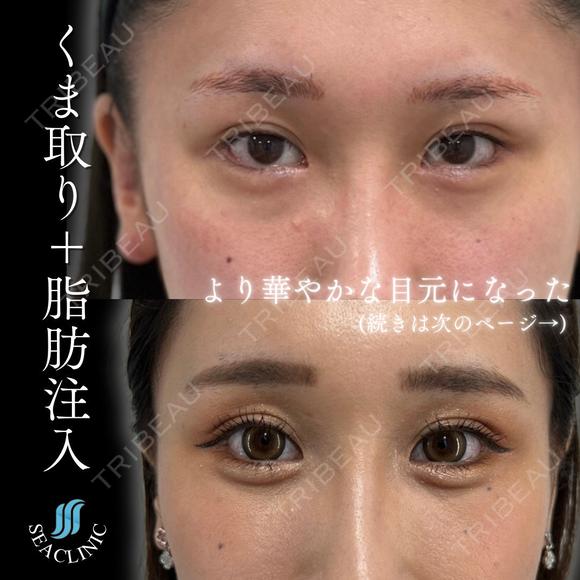 くま取り＋脂肪注入 after画像 メイン用