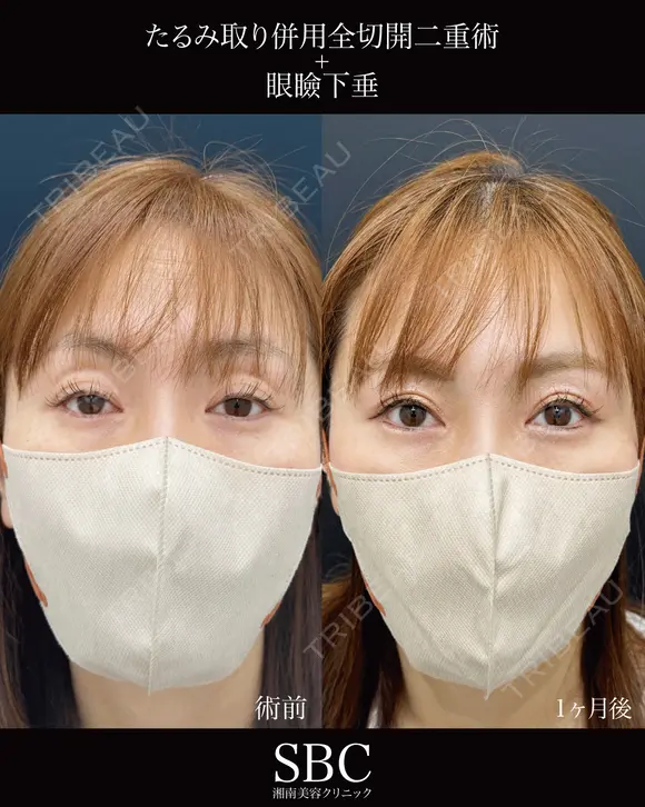 たるみ取り併用全切開二重術・眼瞼下垂 before画像 メイン用