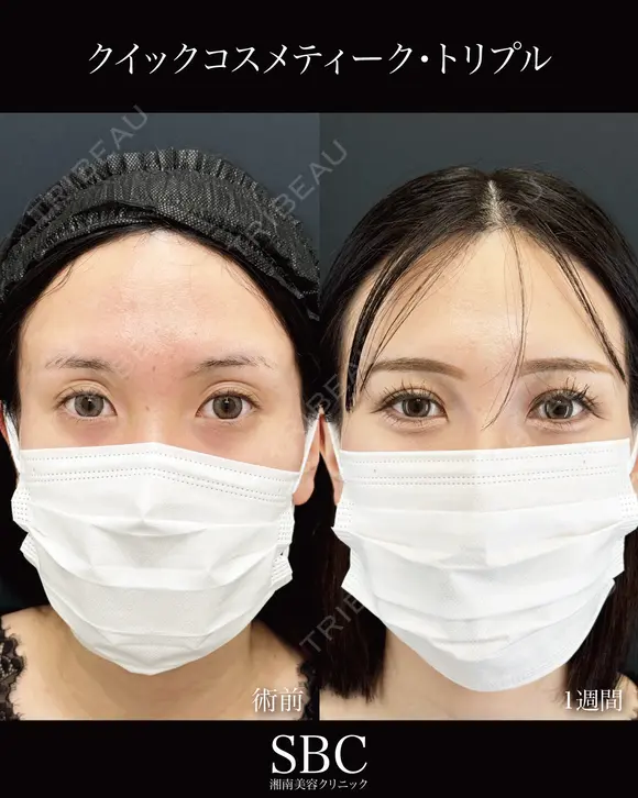 クイックコスメティーク・トリプル before画像 メイン用