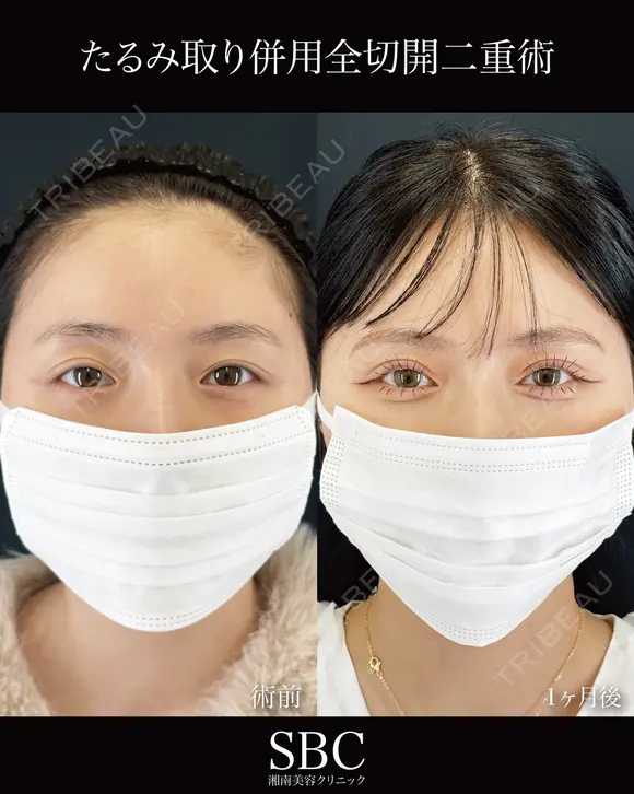 たるみ取り併用全切開二重術 before画像 メイン用
