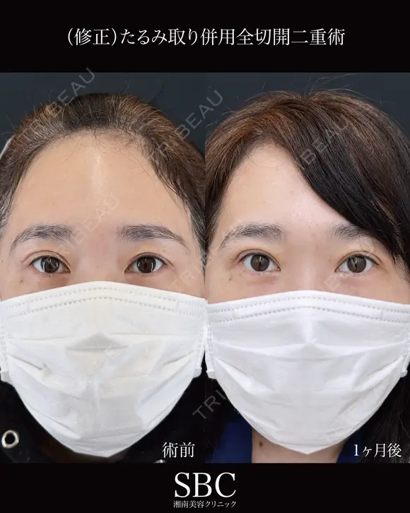 たるみ取り併用全切開二重術 after画像 メイン用