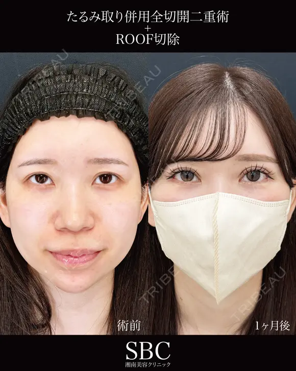 たるみ取り併用全切開二重術・ROOF切除 after画像 メイン用