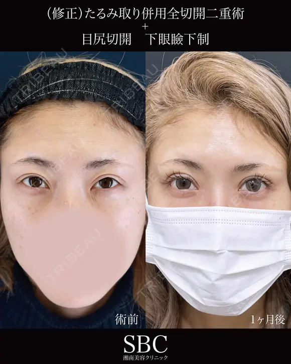 たるみ取り併用全切開二重術・目尻切開・下眼瞼下制 after画像 メイン用