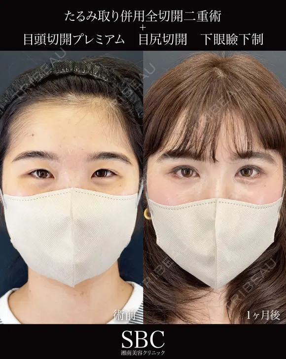 たるみ取り併用全切開二重術・目尻切開・下眼瞼下制・目頭切開 before画像 メイン用