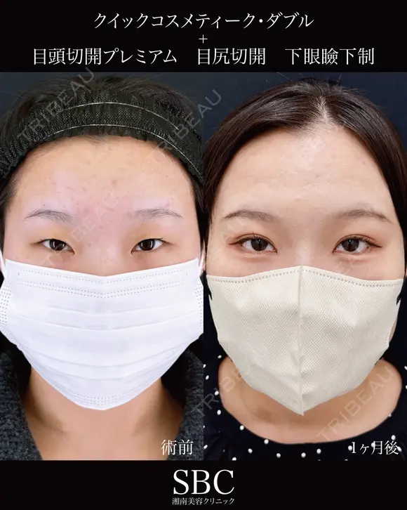 クイックコスメティーク・ダブル・目尻切開・下眼瞼下制・目頭切開 after画像 メイン用